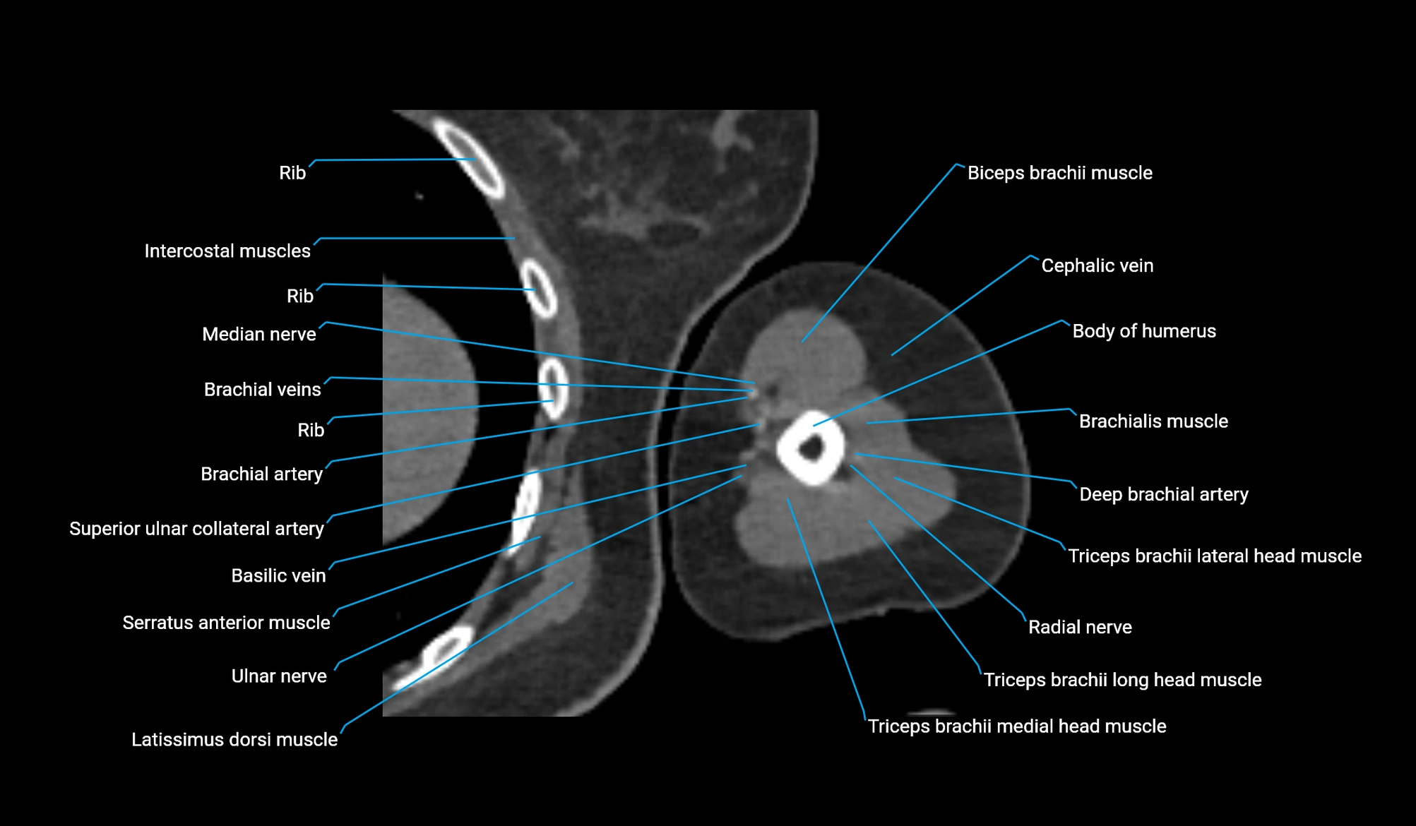 CT upper arm axial  cross sectional anatomy labelled radiology image -00256.webp